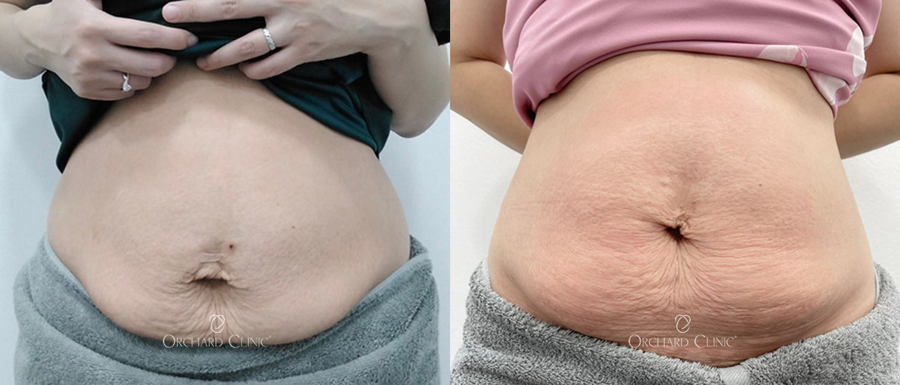 Diastasis Recti before and after case 1