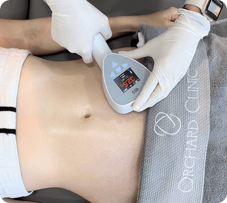 Woman with diastasis recti